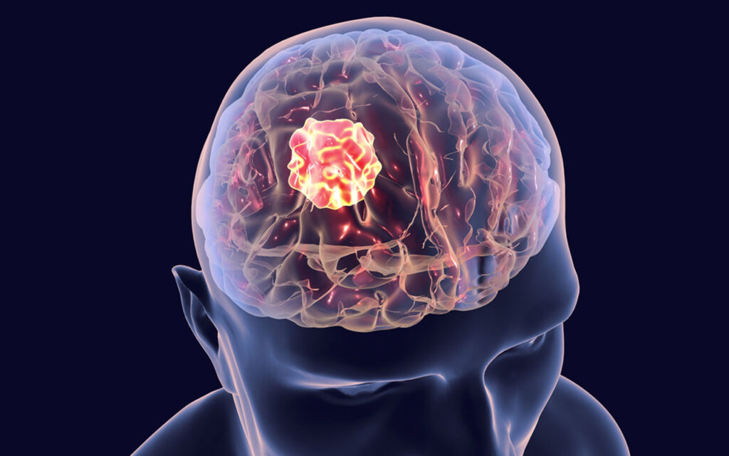 Cep telefonu beyin tümörü riskini artırıyor